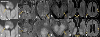 A Single-Health System Case Series of New-Onset CNS Inflammatory Disorders Temporally Associated With mRNA-Based SARS-CoV-2 Vaccines